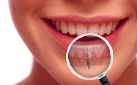 implanturi dentare dr Leahu