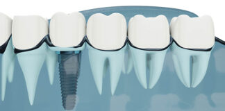 Sponsorizat: Ce urmează după intervenția de implant dentar?