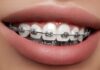Sfaturi utile in tratamentul ortodontic cu aparat dentar de tip Invisalign