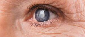 De ce este atat de eficienta operatia de cataracta? 3