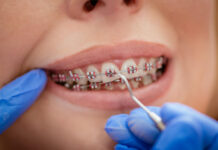Cand este recomandata purtarea unui aparat dentar