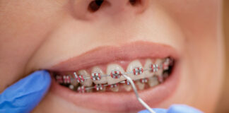 Cand este recomandata purtarea unui aparat dentar