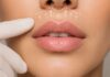 Lip Lift: ce este intervenția care poate modifica proporțiile buzei superioare