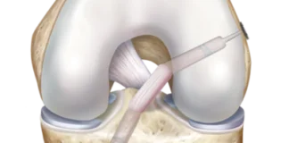 ruptura ligament